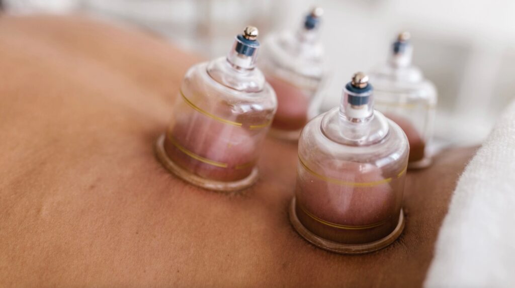 a close up of the lower back with glass cups suctioned to the skin for cupping therapy